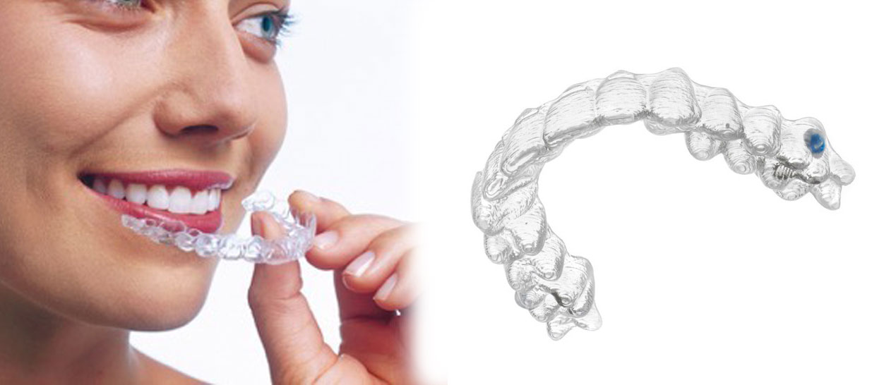 ORTODONZIA INVISIBILE – INVISALIGN